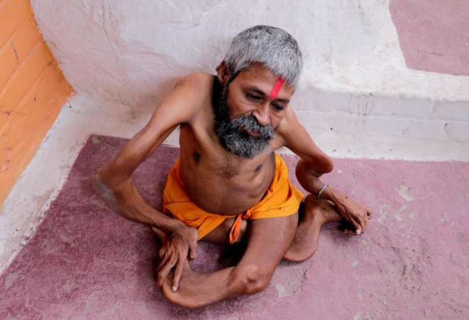 Gặp dị nhân xương xoắn người Ấn Độ - 2 ...nhưng Bharat tin mọi chuyện bắt đầu từ năm 5 tuổi, khi ông bị một bức tường đổ vào người