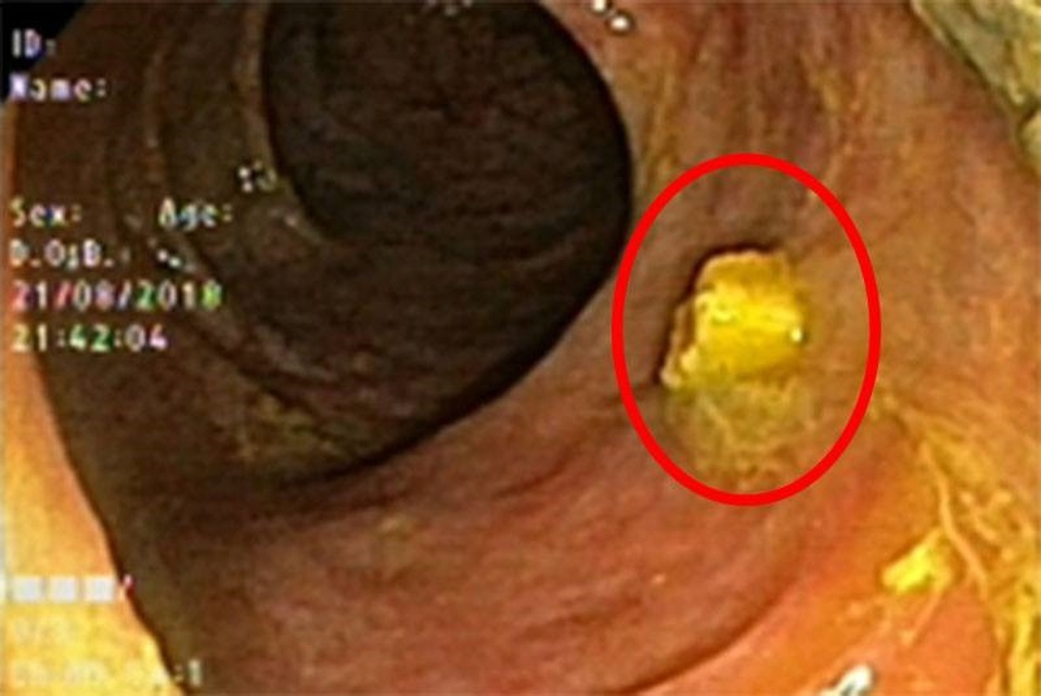 Thủng ruột vì... nuốt răng giả - 2 Dị vật là 2 chiếc răng giả và mấu kim loại được lấy ra từ đường tiêu hóa người bệnh