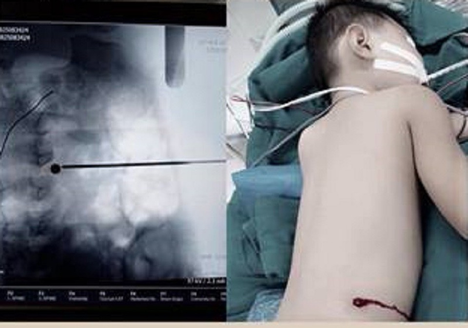 Bé trai nghịch súng bắn chim, đạn xuyên lưng nằm trong đĩa đệm - 1 Bệnh nhi bị viên đạn xuyên vào lưng tại vị trí đốt sống L4 và L5