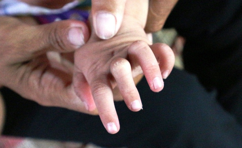 Nhói lòng bé 2 tuổi khóc trắng đêm vì mắc bệnh tim bẩm sinh - 7 Hiện, hai tay, chân của cháu bé có dấu hiệu co quắp lại.