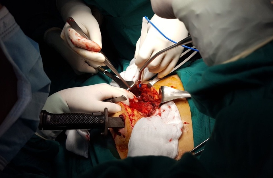 Cân não giành lại sự sống cho bệnh nhân bị dao cắm xuyên ngực - 1 Bệnh nhân nhập viện với con đang đâm xuyên thấu ngực trái