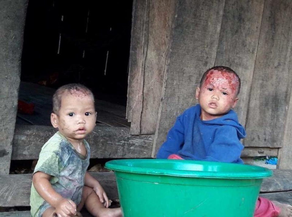 Nhói lòng nhìn 2 cháu nhỏ vùng cao bị lở loét hết da đầu - 2 Hình ảnh cháu Chân và cháu Nghỉ sinh hoạt ở gia đình