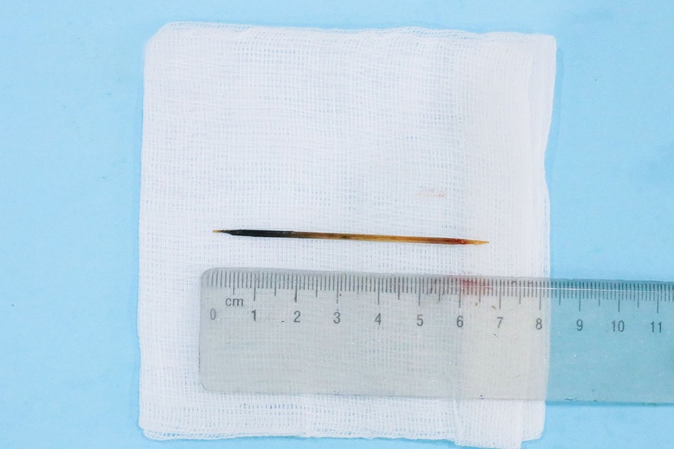 Ngủ quên, nuốt tăm dài 7cm vào bụng - 2 Chiếc tăm dài 7cm được lấy ra từ dạ dày bệnh nhân.