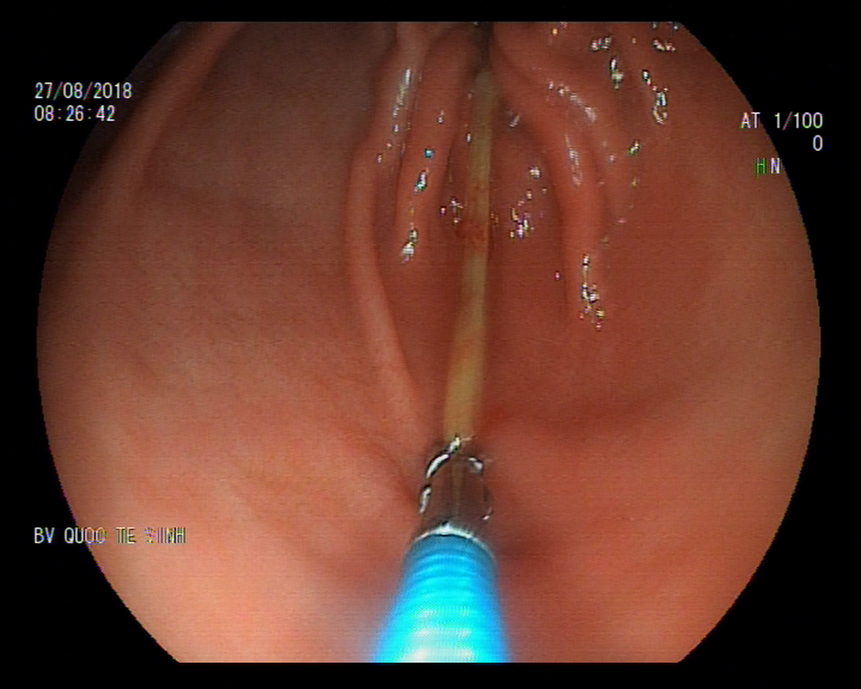 Ngủ quên, nuốt tăm dài 7cm vào bụng - 1 Hình ảnh nội soi chiếc tăm trong dạ dày của bệnh nhân.