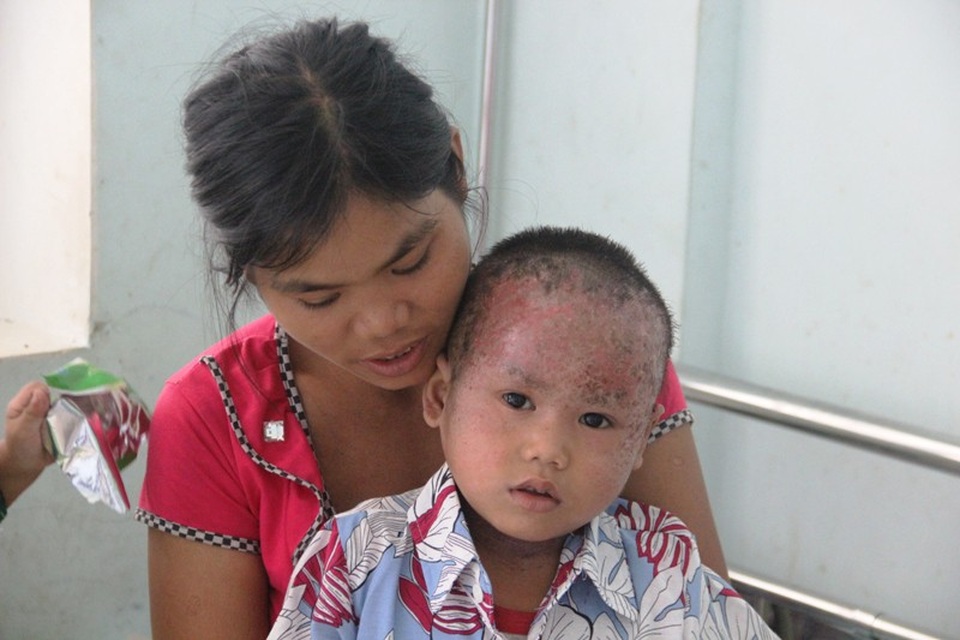 Nhói lòng nhìn 2 cháu nhỏ vùng cao bị lở loét hết da đầu - 4 Khi được nhập viện, các bác sĩ bôi thuốc nên vết thương có dấu hiệu khô ráo