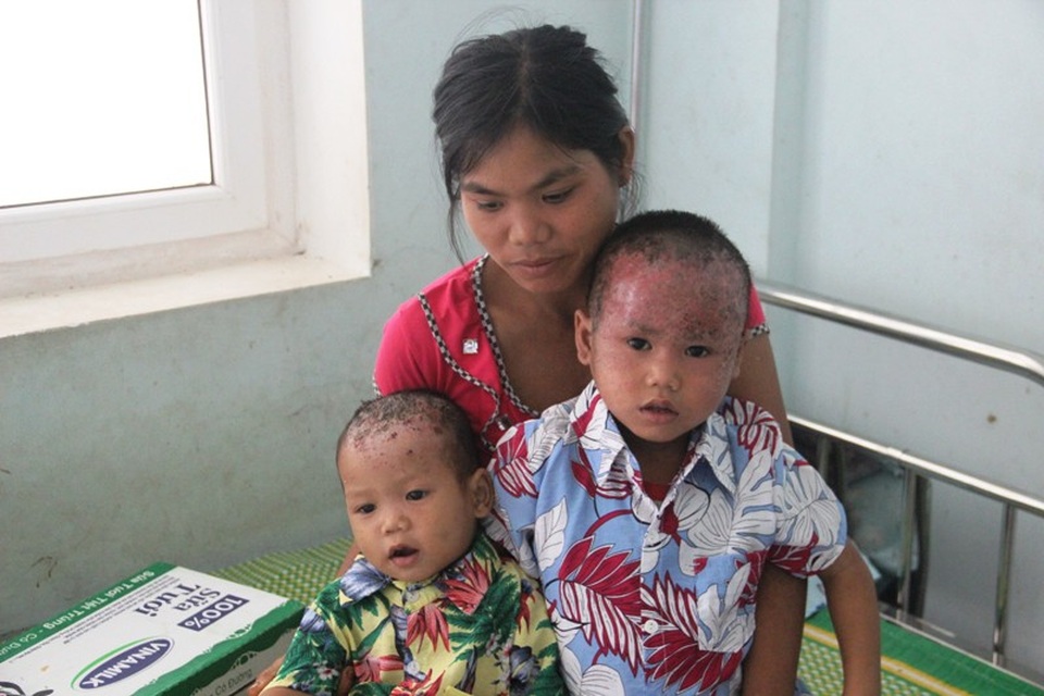 Nhói lòng nhìn 2 cháu nhỏ vùng cao bị lở loét hết da đầu - 5 Tuy nhiên, do bị bệnh trong thời gian dài nên phần da đầu bị bong tróc nặng