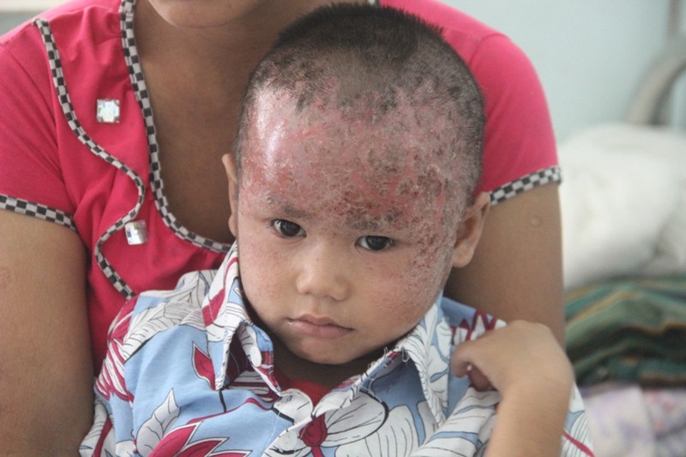 Nhói lòng nhìn 2 cháu nhỏ vùng cao bị lở loét hết da đầu - 7 Gia đình đã đưa cháu về khám tại Trung tâm Y tế huyện nhưng bệnh chưa dứt điểm