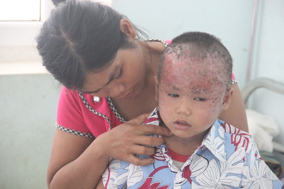 Nhói lòng nhìn 2 cháu nhỏ vùng cao bị lở loét hết da đầu - 9 Hai cháu phải chịu sự đau đớn, khó chịu
