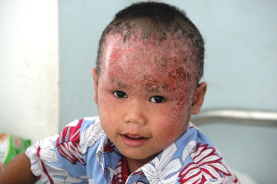 Nhói lòng nhìn 2 cháu nhỏ vùng cao bị lở loét hết da đầu - 10 Phần trước đầu và trán bị viêm, lở loét
