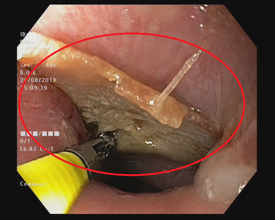 Việt Nam sút tung lưới đối phương, cổ động viên hóc xương cá - 1 Chiếc xương cá mắc ngang thực quản bệnh nhân