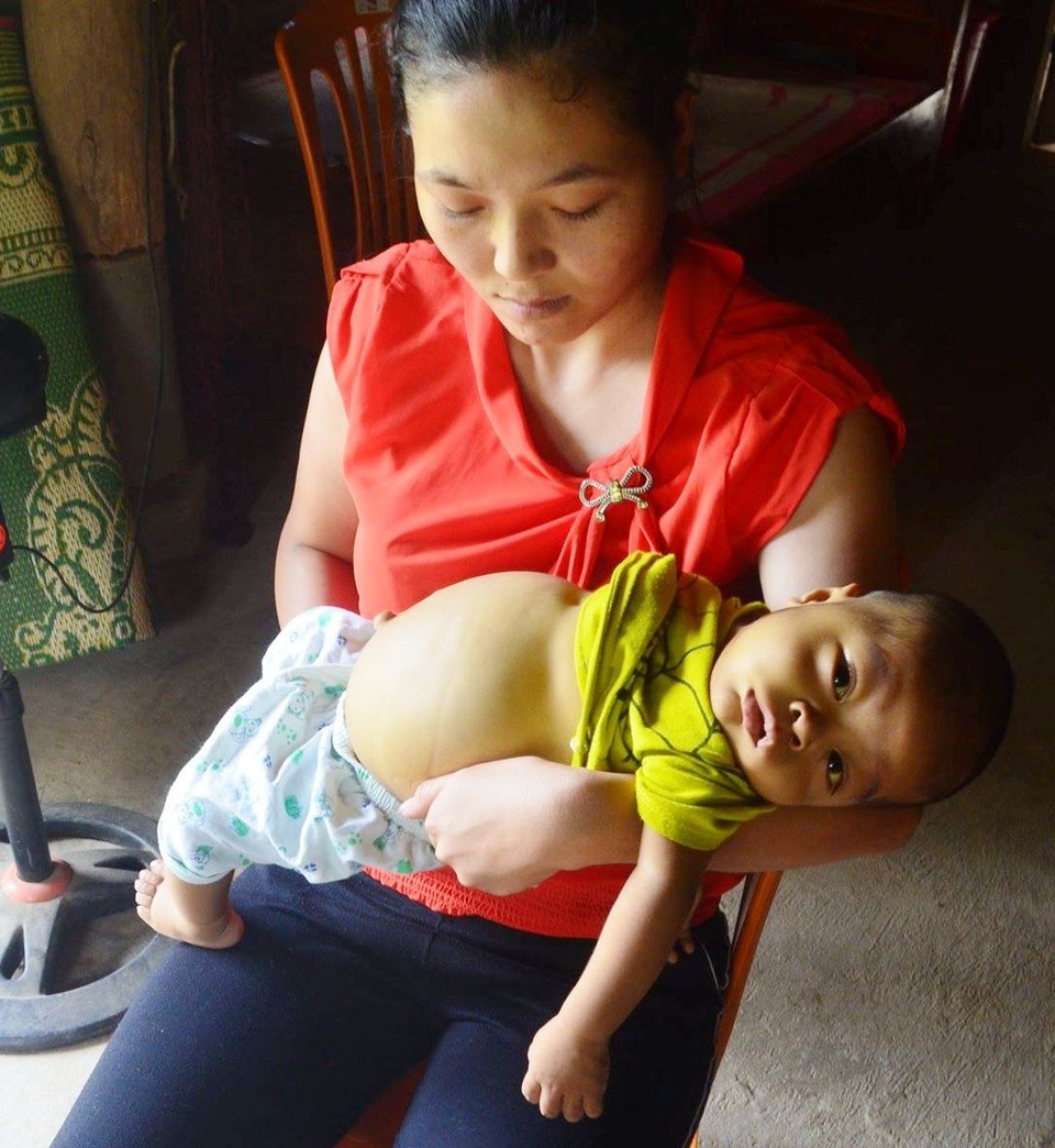 Không tiền chữa trị, bé 8 tháng tuổi bụng to như cái trống chờ chết từng ngày - 1 Mặc dù mới 8 tháng tuổi nhưng cháu Duy phải mang căn bệnh teo ống mật bẩm sinh, đảo ngược nội tạng, lệch tim quái ác.