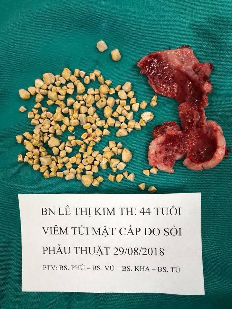 Túi mật hoại tử vì chứa gần 250 viên sỏi - 1 Hàng trăm viên sỏi được lấy ra từ túi mật của bệnh nhân