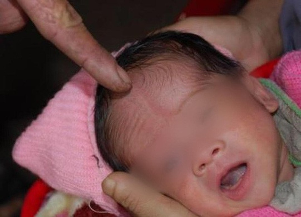 Bé trai 6 tháng tuổi nguy kịch sau khi được chữa “mở khoá đầu” - 2 Nhiều người dân quan niệm rằng trẻ có rãnh trên trán phải chữa mở khóa đầu (Ảnh minh họa)