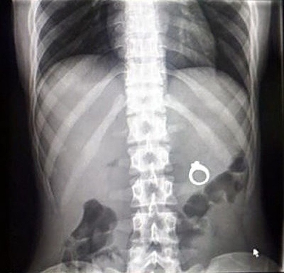 Bất ngờ với những bức hình chụp X-quang kỳ lạ nhất được chia sẻ - 11 Có lẽ “nửa kia” của nhân vật trong bức ảnh đã học theo các màn cầu hôn trên internet và giấu chiếc nhẫn vào trong đồ ăn.