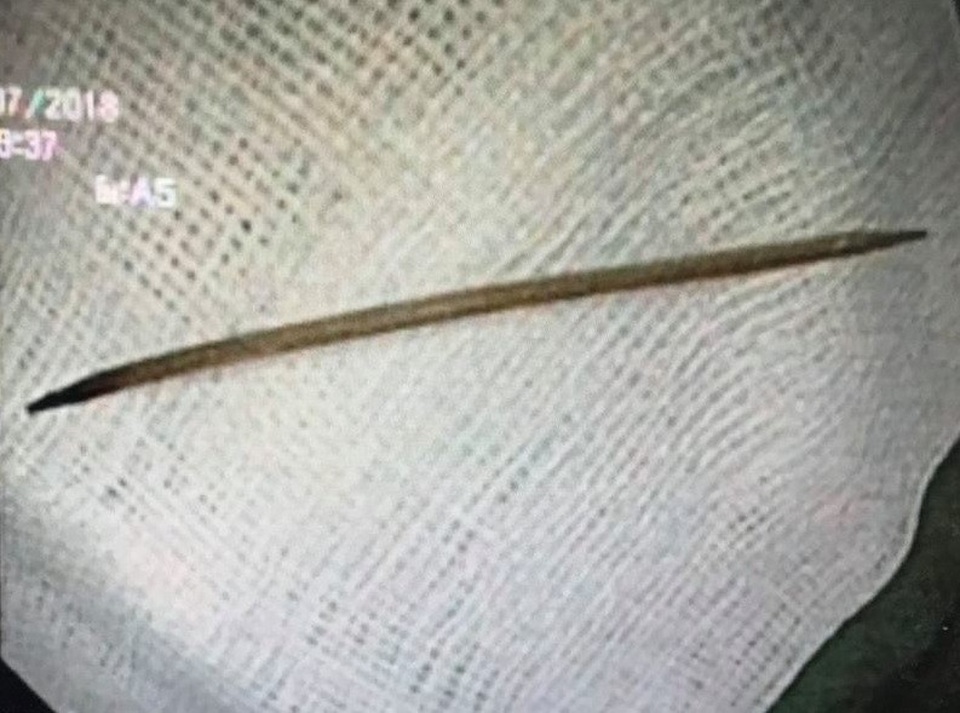 Cây tăm nhọn 2 đầu được lấy ra từ dạ dày của người bệnh