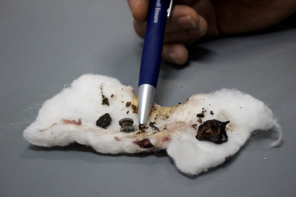 Hy hữu lưỡi câu, cục sắt nằm trong phế quản bệnh nhân tâm thần - 1
Các dị vật nằm trong phế quản của bệnh nhân T. được bác sĩ gắp ra ngoài