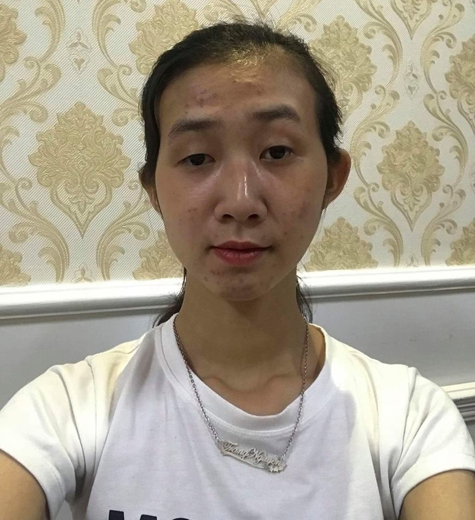 Xôn xao chuyện cô gái than “không muốn sống” vì bị chê xấu - 1 Với gương mặt lệch đã kéo theo mắt cô gái bên cụp bên xòe làm cô luôn mặc cảm mình xấu, thậm chí có suy nghĩ tiêu cực.