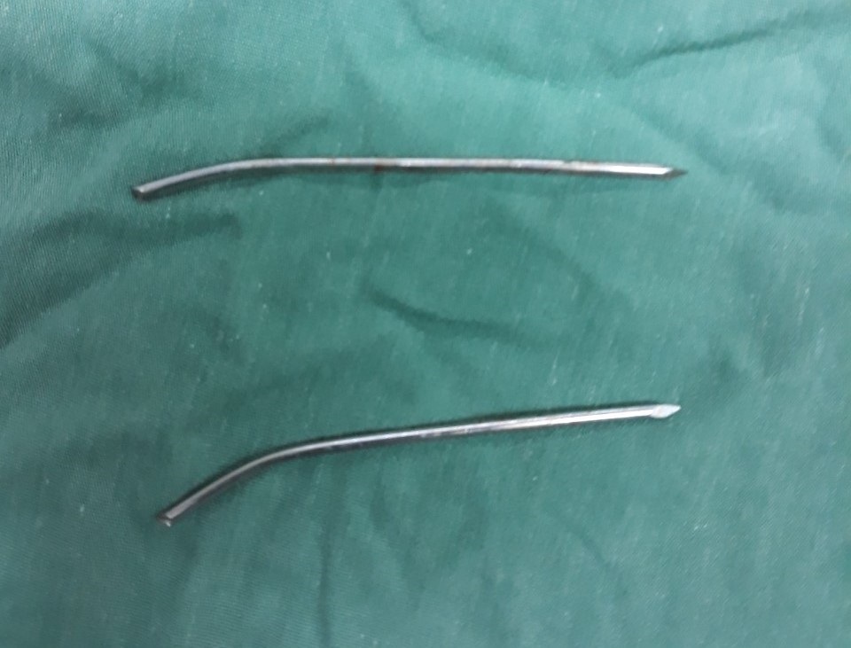 Hai chiếc đinh được các bác sĩ phẫu thuật lấy ra