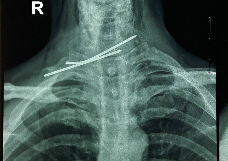 Hai chiếc đinh qua kết quả chụp X.Quang