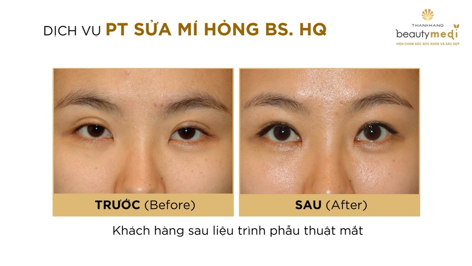 Thượng vàng hạ cám thị trường phẫu thuật thẩm mỹ Mắt ở Việt Nam - 2 Rất nhiều khách hàng lựa chọn sai trung tâm thẩm mỹ, dẫn tới trường hợp tiền mất, tật mang phải chỉnh sửa lại nhiều lần
