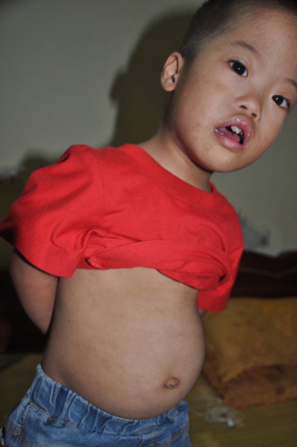 Không vay nổi 20 triệu đồng, tính mạng bé 3 tuổi nguy kịch vì bệnh tim - 4 Phần bụng to hơn bình thường của bé Quyền.