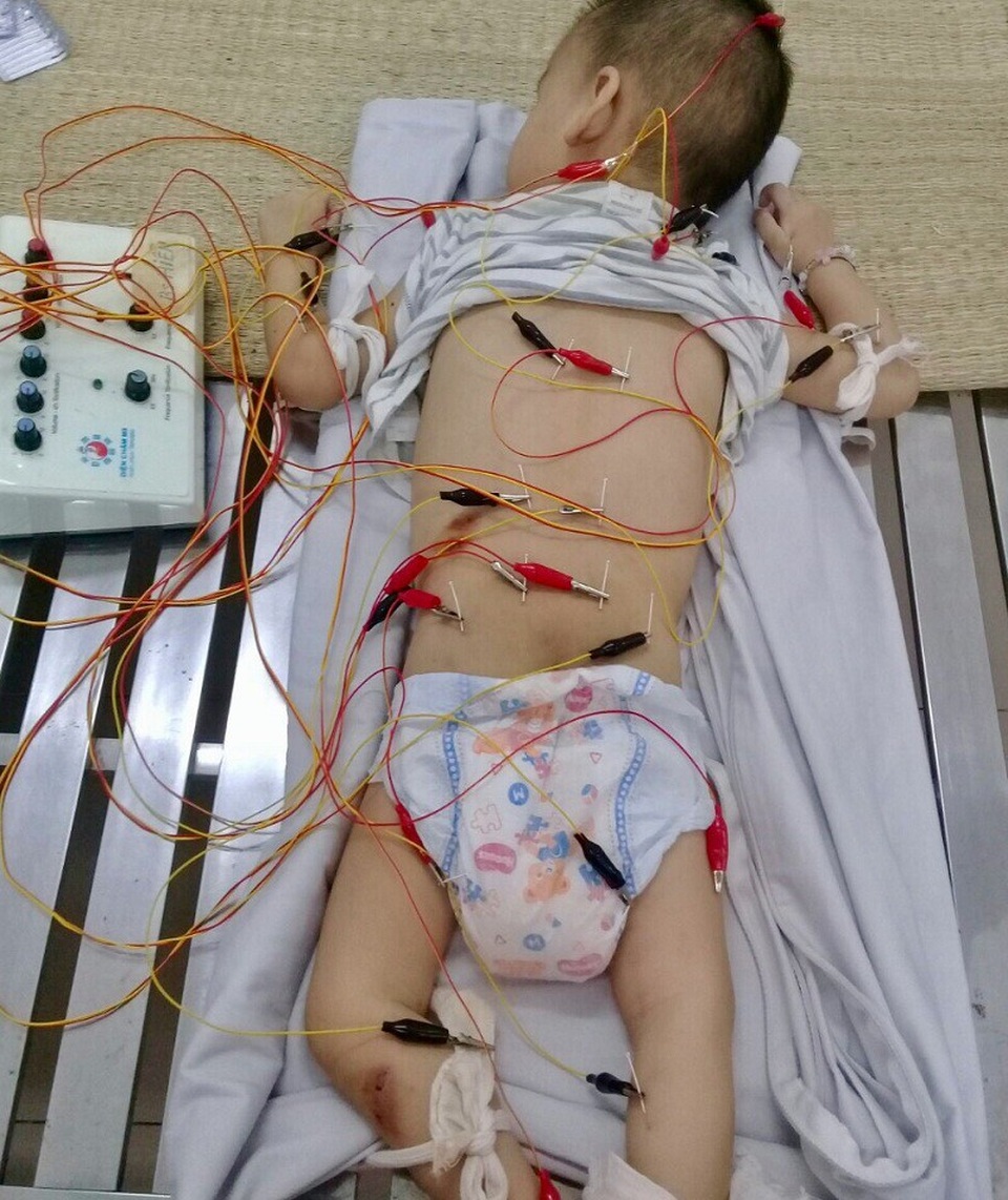 Cuộc sống cùng cực của vợ chồng nghèo có hai con bị bại não, tim bẩm sinh - 4 Thân hình nhỏ bé cắm đầy những mũi kim trong liệu trình điều trị