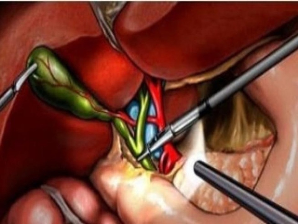 Cắt bỏ túi mật có ảnh hưởng đến tiêu hóa? - 1 Cắt bỏ túi mật có ảnh hưởng đến tiêu hóa? - 1