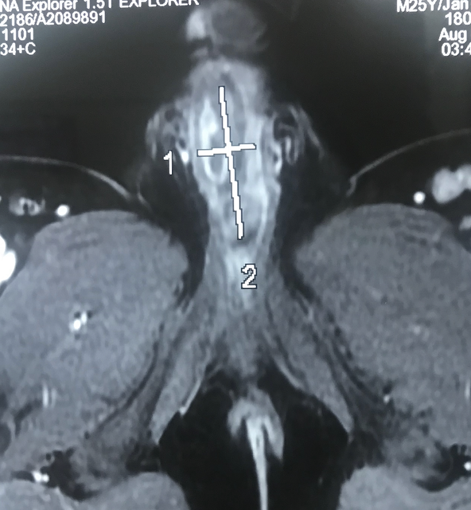 Dương vật lở loét vì cuộn cước 11 năm trong niệu đạo - 1 Hình ảnh MRI phát hiện vật lạ nằm trong niệu đạo của người bệnh