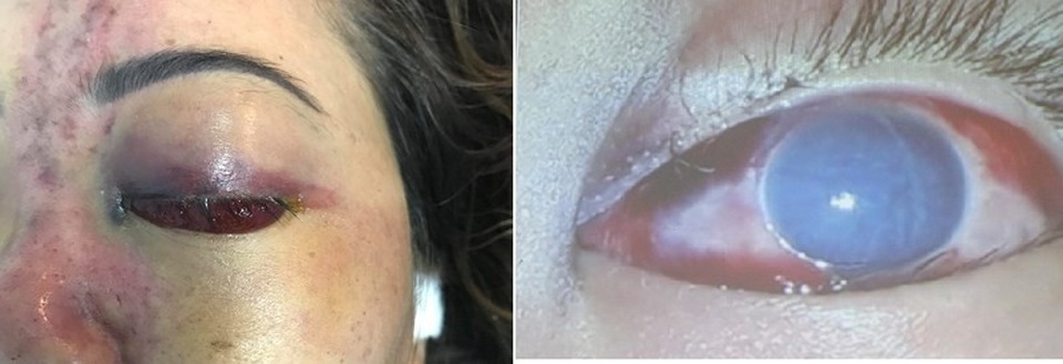 Vì sao tiêm filler nâng mũi dễ gây mù mắt? - 1 Mắt chị D. không còn nhìn thấy và vùng da mũi xuất huyết nặng sau khi tiêm filler. Ảnh: HL