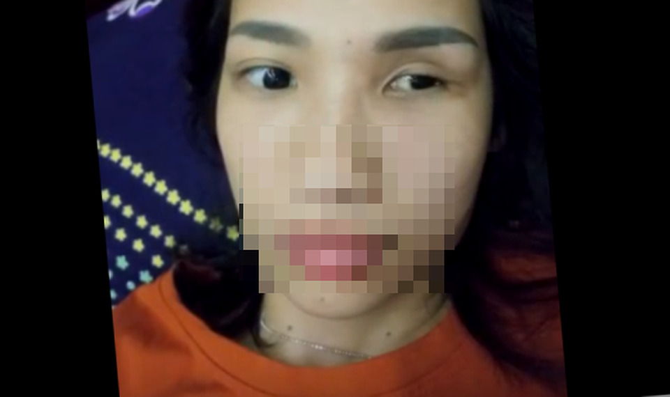 Vì sao tiêm filler nâng mũi dễ gây mù mắt? - 2 Mắt trái của chị L. không còn nhìn thấy và bị teo lại. Ảnh: HL