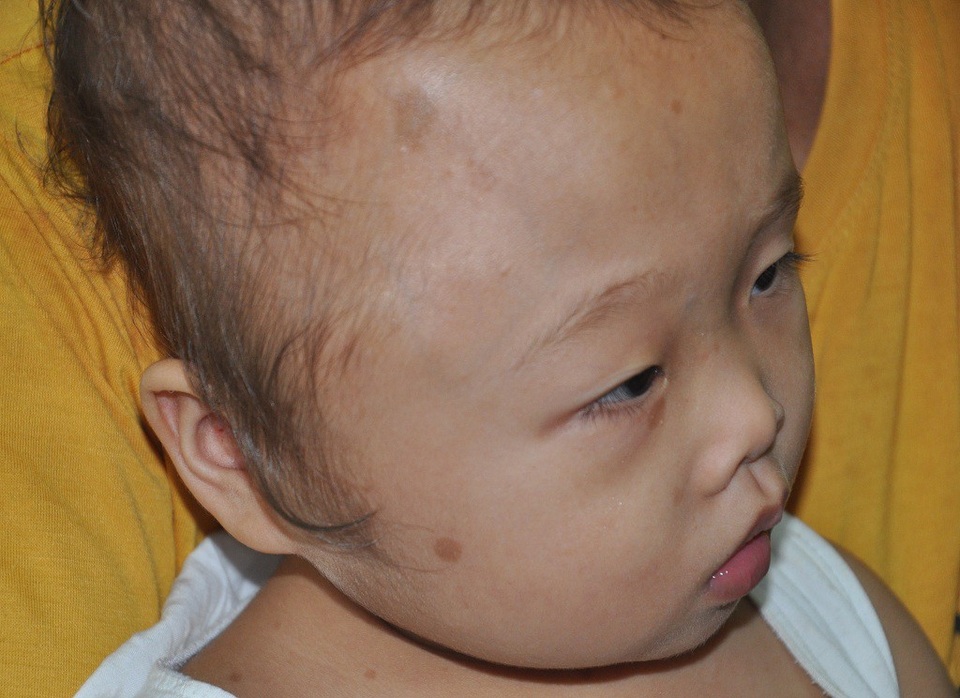Bị u màng nhện, bé 2 tuổi mang khuôn mặt lệch to bất thường - 2 Bị u màng nhện, bé 2 tuổi mang khuôn mặt lệch to bất thường - 2