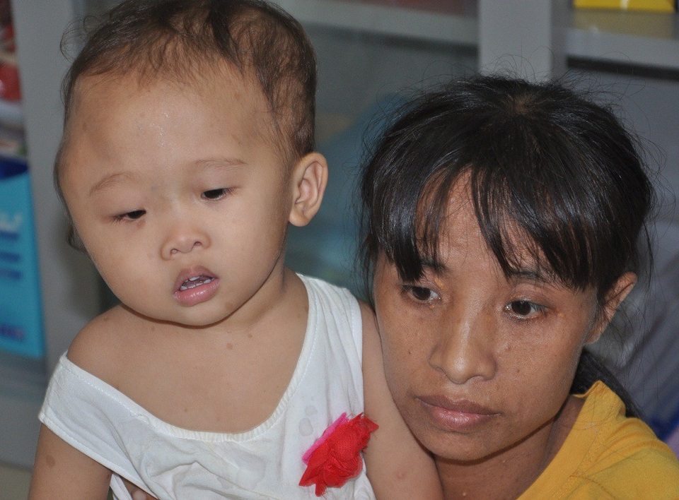 Bị u màng nhện, bé 2 tuổi mang khuôn mặt lệch to bất thường - 6 Liệu có phép màu nào đến với cô bé Minh Tâm?