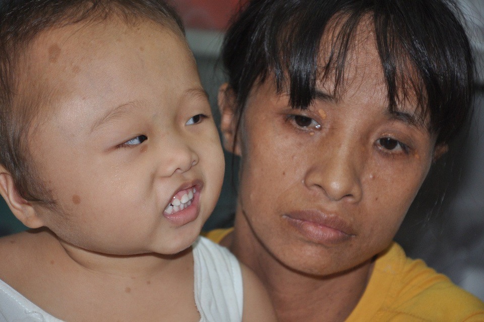 Bị u màng nhện, bé 2 tuổi mang khuôn mặt lệch to bất thường - 5 Nụ cười hồn nhiên của con nhưng trái tim mẹ đau đớn như có trăm nghìn mũi dao đâm.