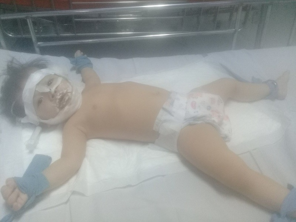 Bé gái 18 tháng tuổi bị bỏng nặng ở nhà trẻ - 2 Sau 10 ngày điều trị, sức khỏe bệnh nhi đã tạm ổn