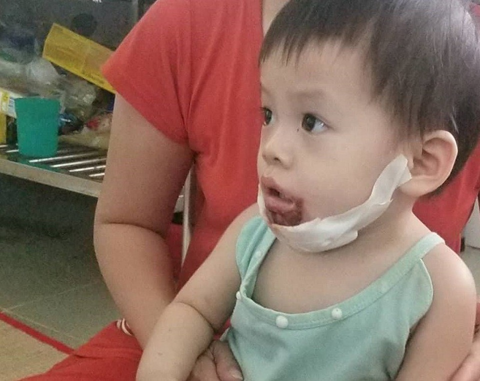 Vụ bé gái bị bỏng miệng: Gia đình trông trẻ nhận trách nhiệm - 1 Bé Ngân bị bỏng vùng miệng, cằm sau gần 2 tuần điều trị vết thương đang bình phục