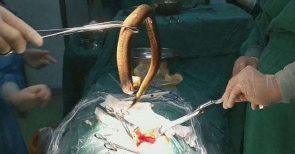 Người đàn ông lĩnh hậu quả vì nuốt lươn sống dài 30cm vào bụng - 2 Con lươn được các bác sĩ gắp ra ngoài.