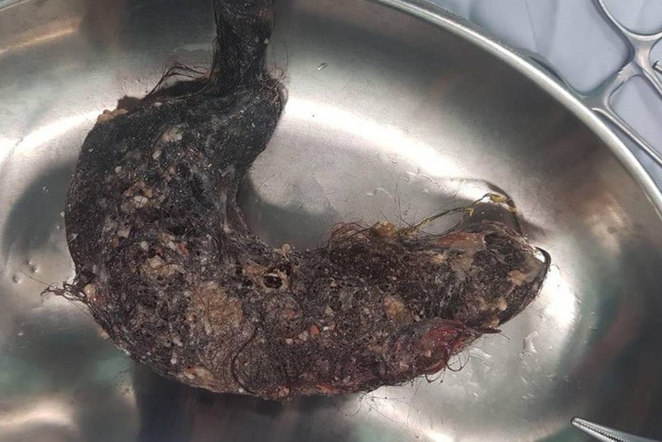 Búi tóc nặng gần 1kg trong dạ dày bé gái - 1 Búi tóc nằm trong dạ dày bệnh nhi được bác sĩ phẫu thuật lấy ra ngoài