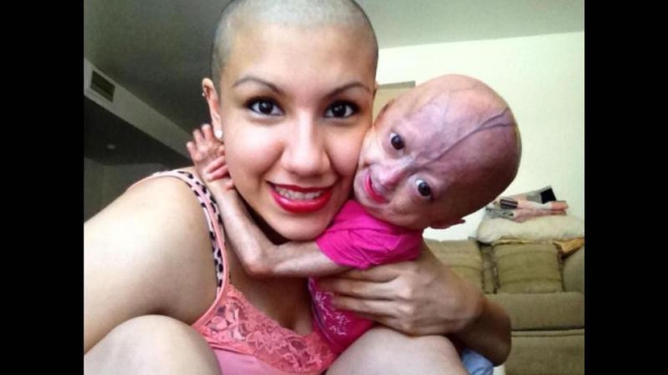 Mắc hội chứng lão hóa hiếm gặp, bé 11 tuổi vẫn trở thành ngôi sao mạng - 3 Bé gái chụp ảnh cùng mẹ