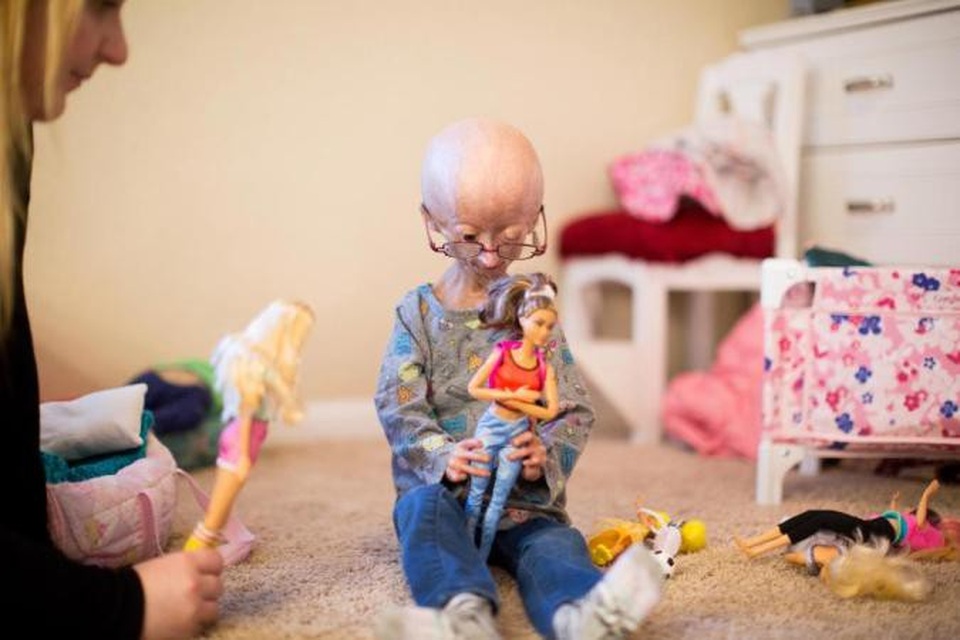 Mắc hội chứng lão hóa hiếm gặp, bé 11 tuổi vẫn trở thành ngôi sao mạng - 4 Cô bé gầy gò như một con búp bê