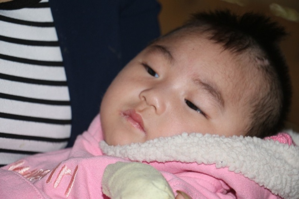 Thương bé 1 tuổi mang bệnh não úng thủy - 6 Thương bé 1 tuổi mang bệnh não úng thủy - 6
