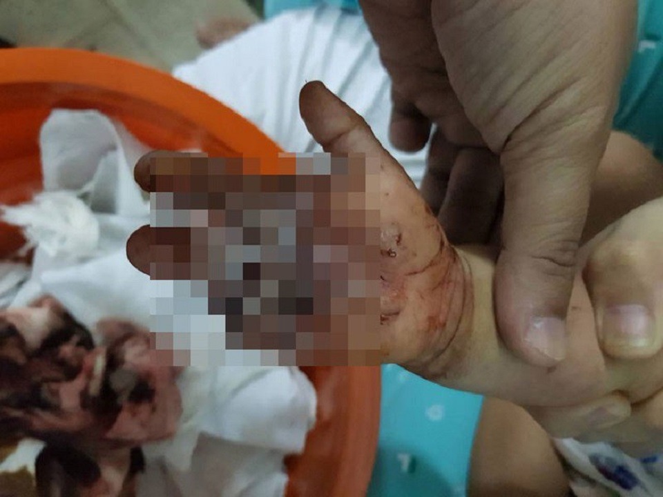 Bàn tay của bé bị đứt lìa, dập nát, ngón trỏ và ngón út không thể điều trị bảo tồn