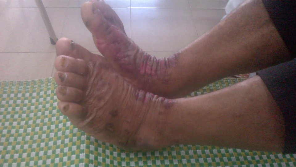 Từ đầu tháng 12/2017 đến nay, Hội chứng viêm da dày sừng bàn tay, bàn chân tái phát tại huyện Ba Tơ với 7 trường hợp mắc bệnh