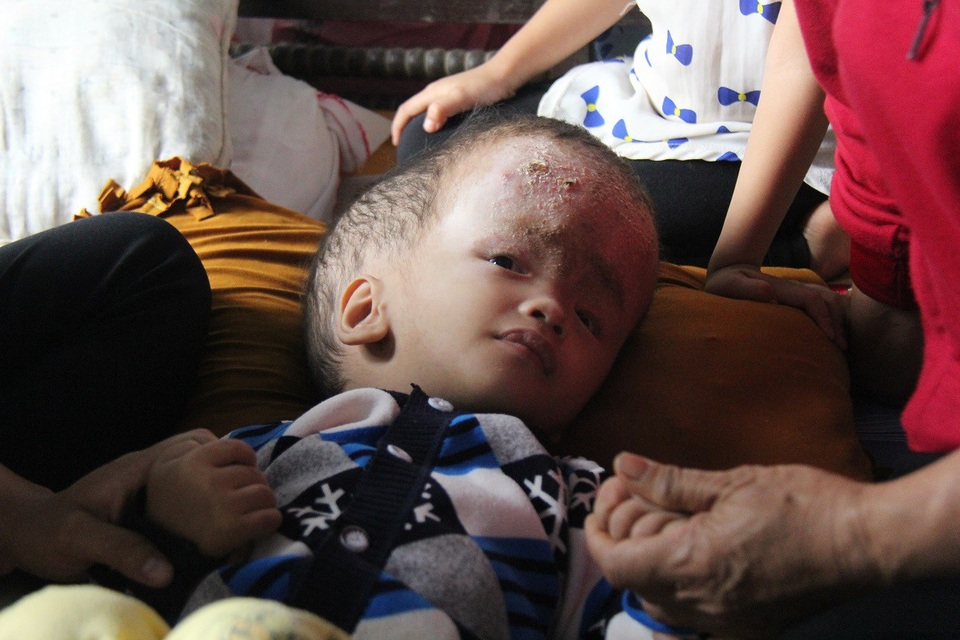 “Đầu cháu sắp nổ tung, nhưng vợ chồng em cùng đường rồi !” - 6 Ánh mắt tội nghiệp của đứa trẻ mắc bệnh hiểm nghèo