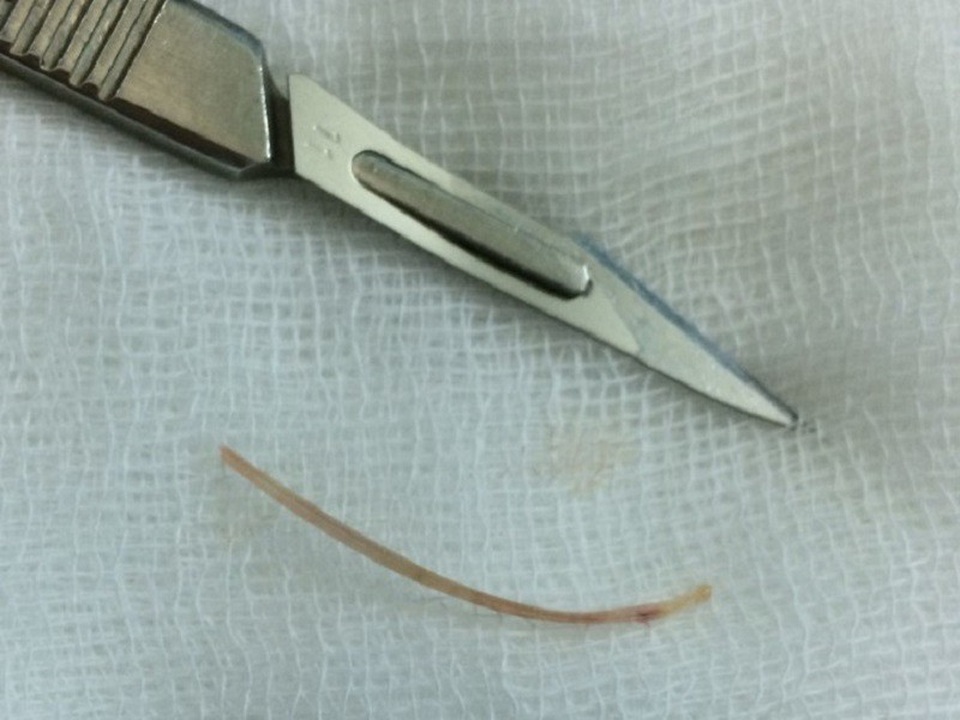 Chiếc xương cá được nội soi gắp ra từ đường tiêu hóa của người bệnh