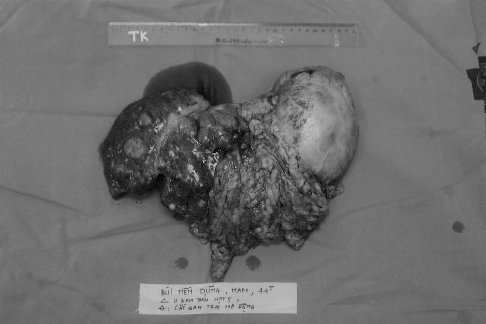 Dù mới phát hiện, nhưng khối u gan của bệnh nhân phát triển rất nhanh. Ảnh: BS cung cấp.