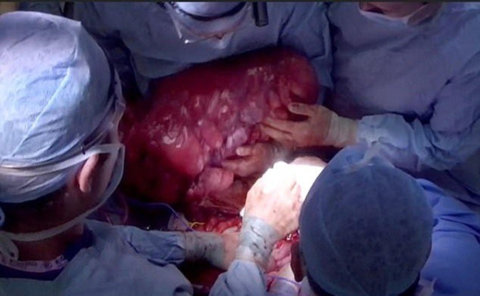 Bác sĩ phải ôm khối u bằng cả hai tay