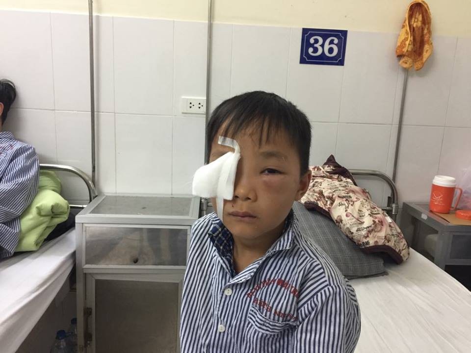 Bé 8 tuổi bị chó cắn rách giác mạc - 1 Bé 8 tuổi bị chó cắn rách giác mạc - 1