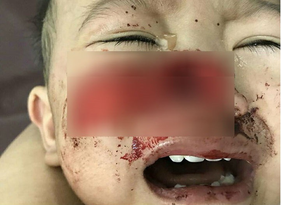 Liên tiếp hai bé trai bị chó nhà cắn nát mặt, rách cổ - 1