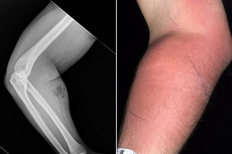 Người đàn ông tự tiêm… tinh trùng để chữa đau lưng - 1