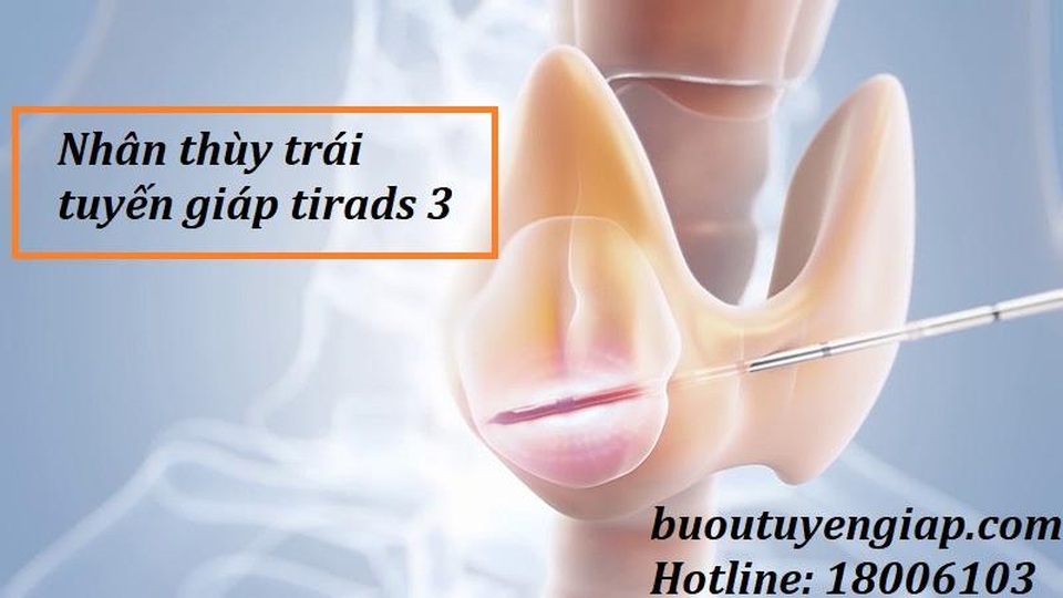 Nhân thùy trái tuyến giáp tirads 3 có nguy hiểm không? - 1 Nhân thùy trái tuyến giáp tirads 3 có nguy hiểm không? - 1